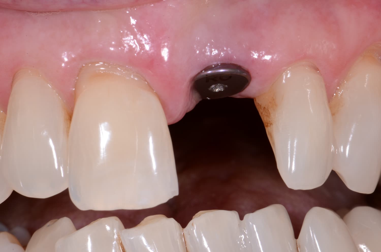Cosmetic Implant Restoration.JPG