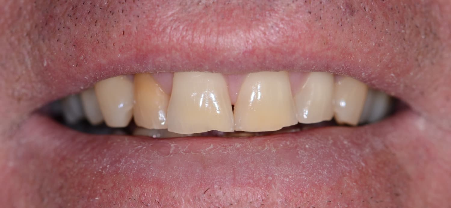 Same Day Veneers.JPG