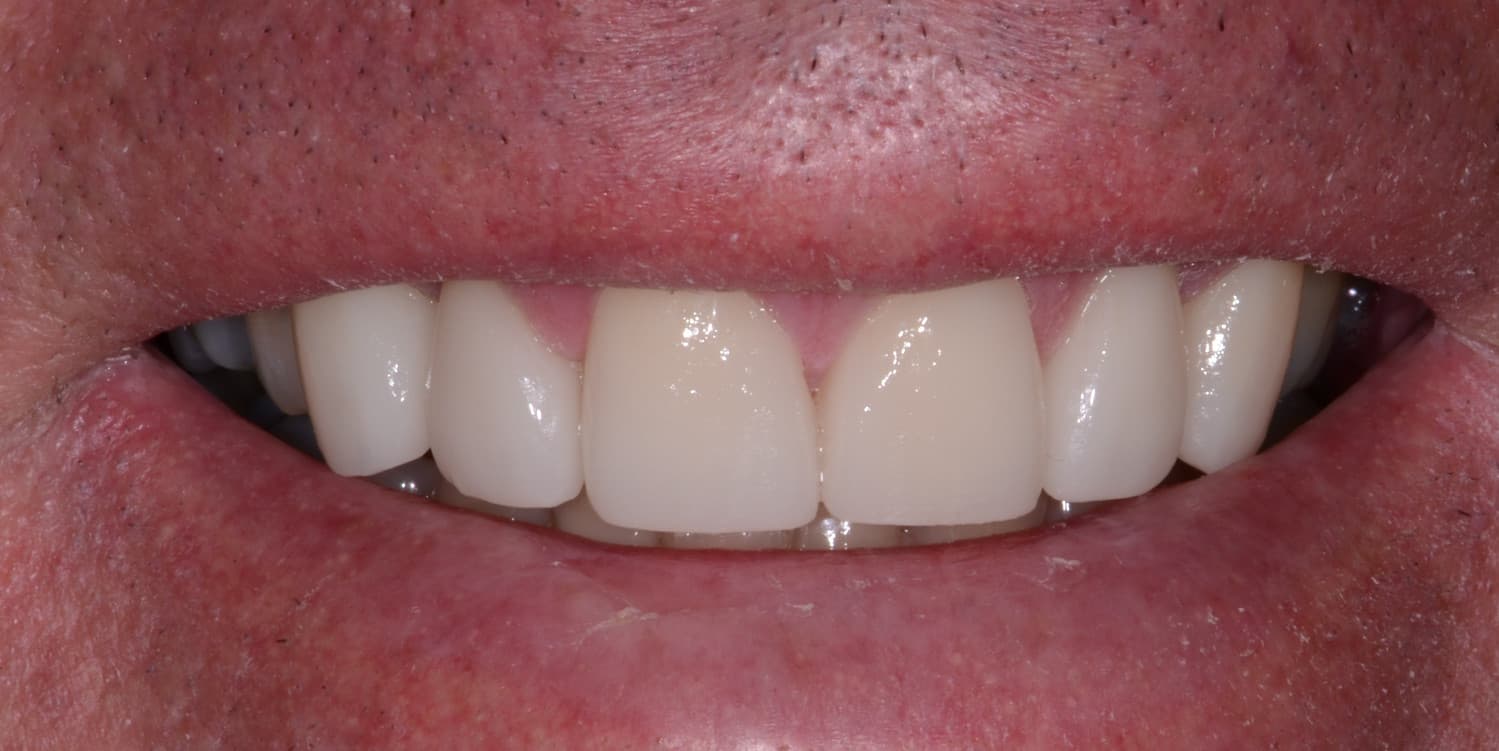 Same Day Veneers.JPG