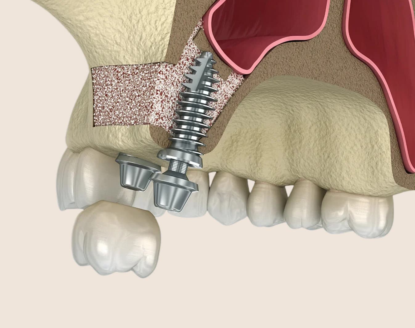 Dr. Ghandehari explaining a dental bone graft procedure to a patient at Rancho Bernardo Dental Arts