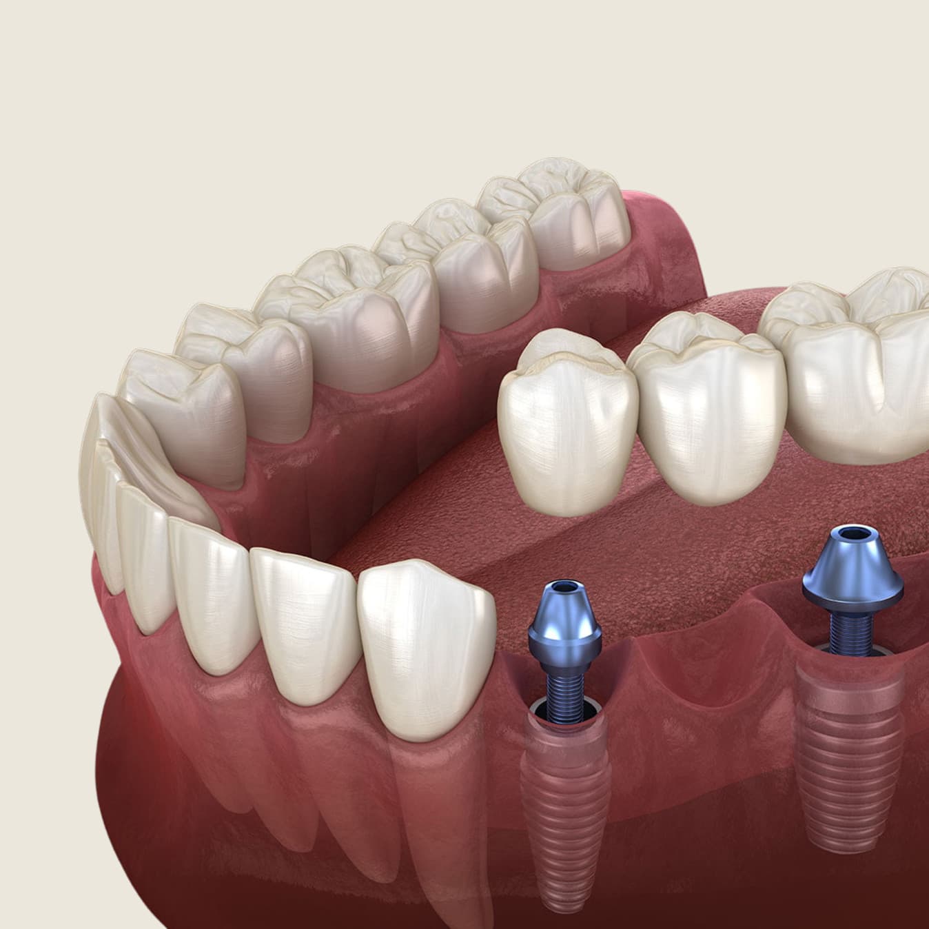 Dentist comparing a dental bridge and implant model with a patient at Rancho Bernardo Dental Arts