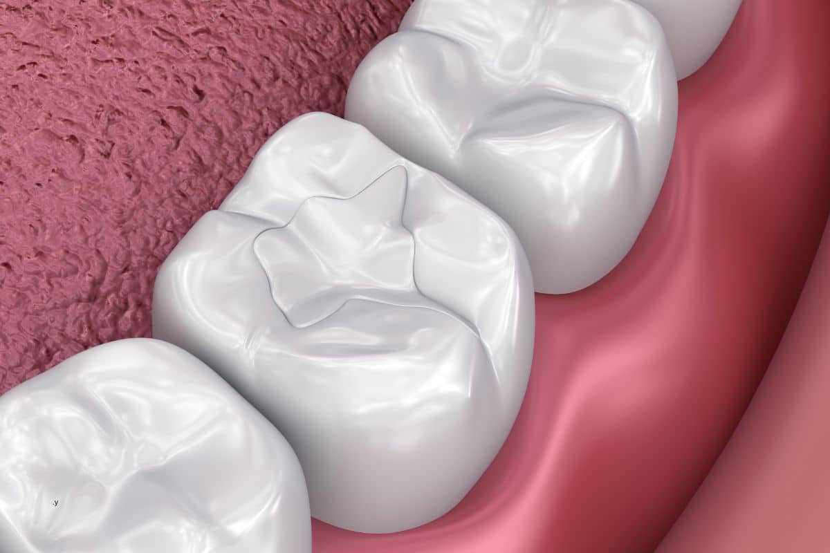 Shade matched composite resin filling completed at Rancho Bernardo Dental Arts