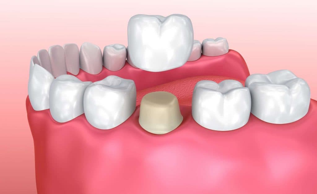 Dental crown with core build up restoring a damaged tooth at Rancho Bernardo Dental Arts