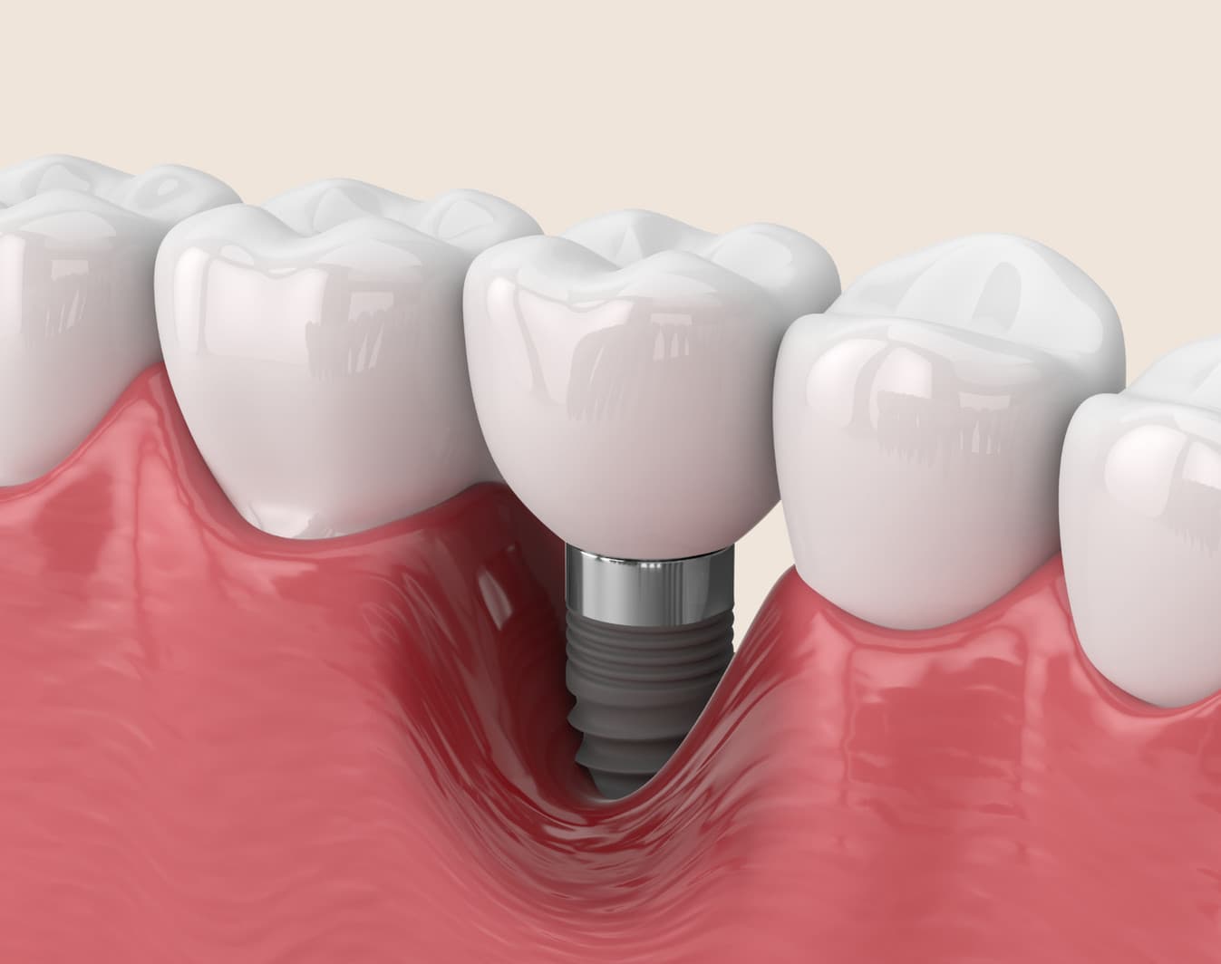 3D guided dental implant surgery planning on screen at Rancho Bernardo Dental Arts