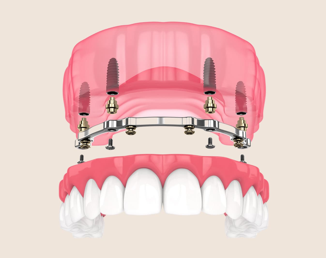 Locator attachment overdenture secured by implants at Rancho Bernardo Dental Arts