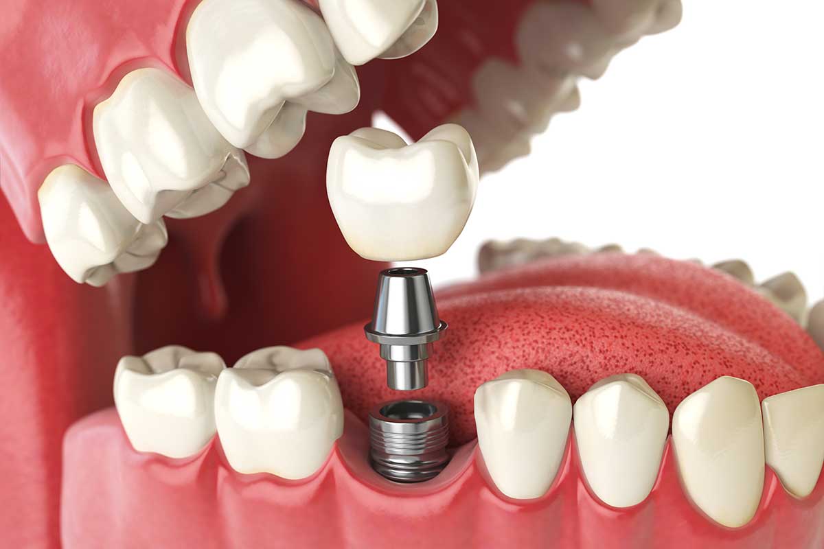 Single tooth implant with crown restoring a complete smile at Rancho Bernardo Dental Arts