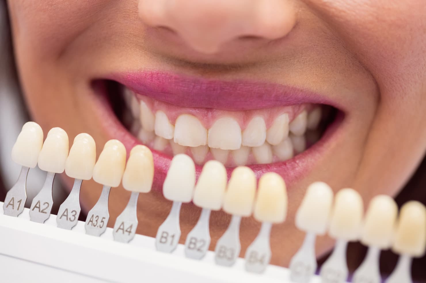 Porcelain Veneers in Rancho Bernardo: What to Expect, Who Qualifies, and How Long They Last