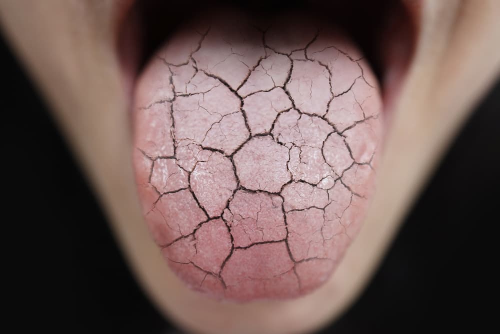 The Anti-Drooler