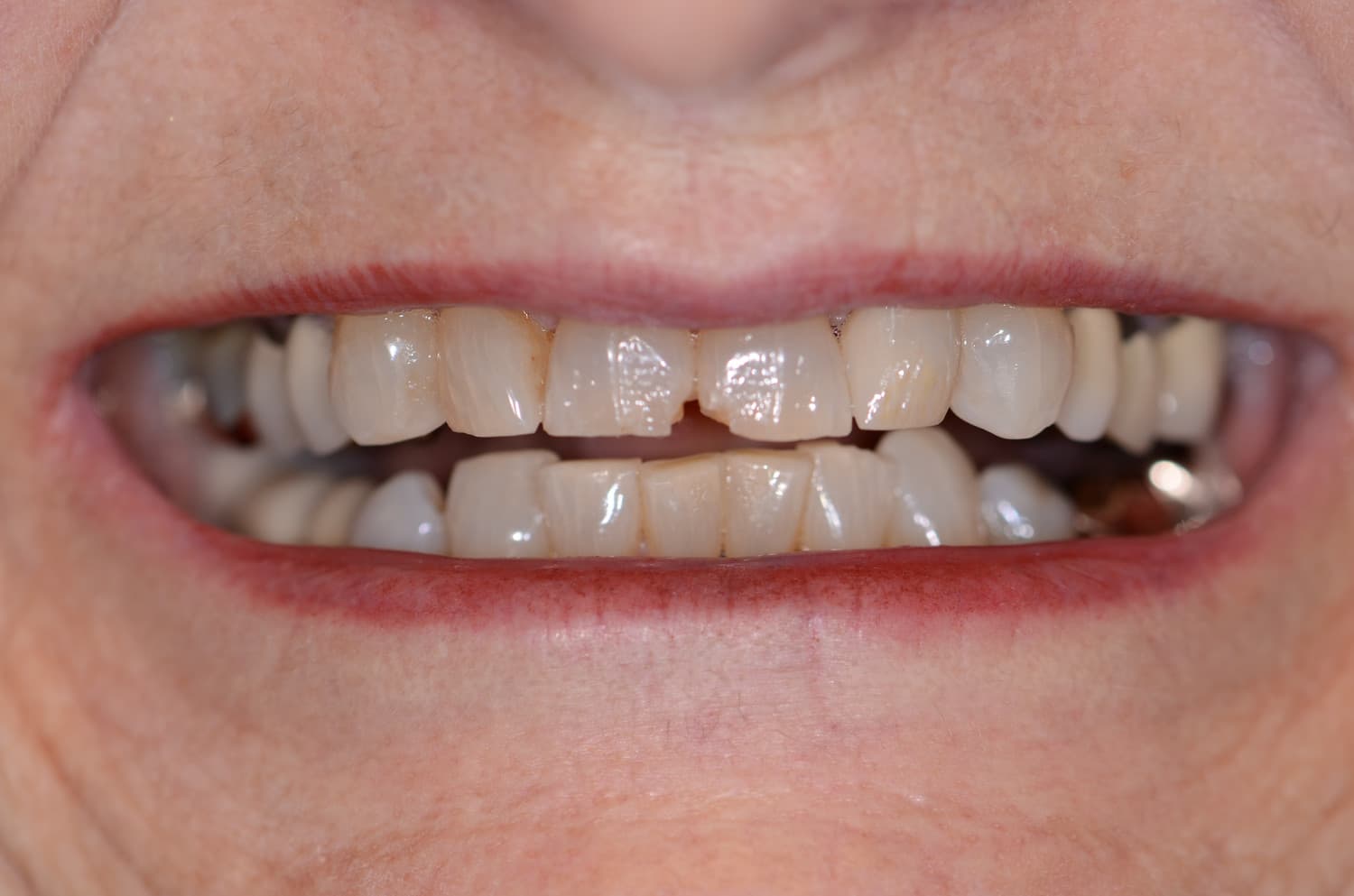 Smile makeover, before treatment