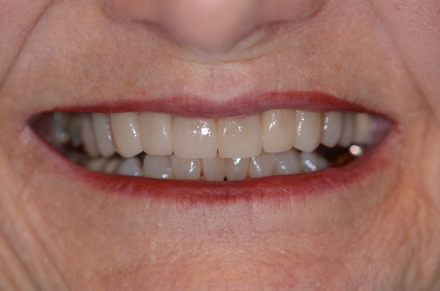 Smile makeover, after treatment