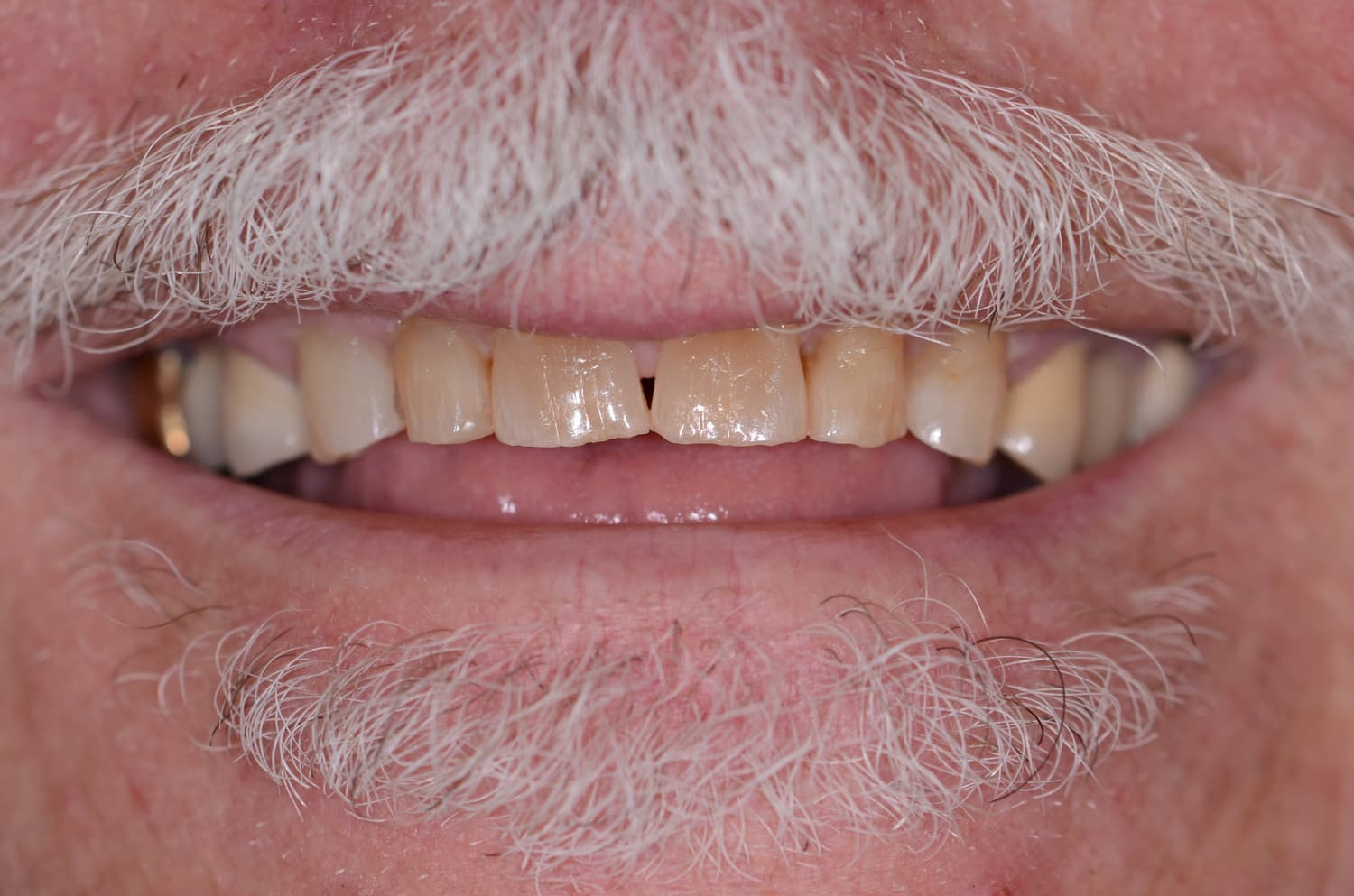 Smile makeover, before treatment