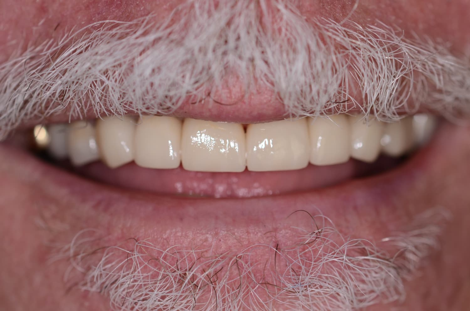 Smile makeover, after treatment
