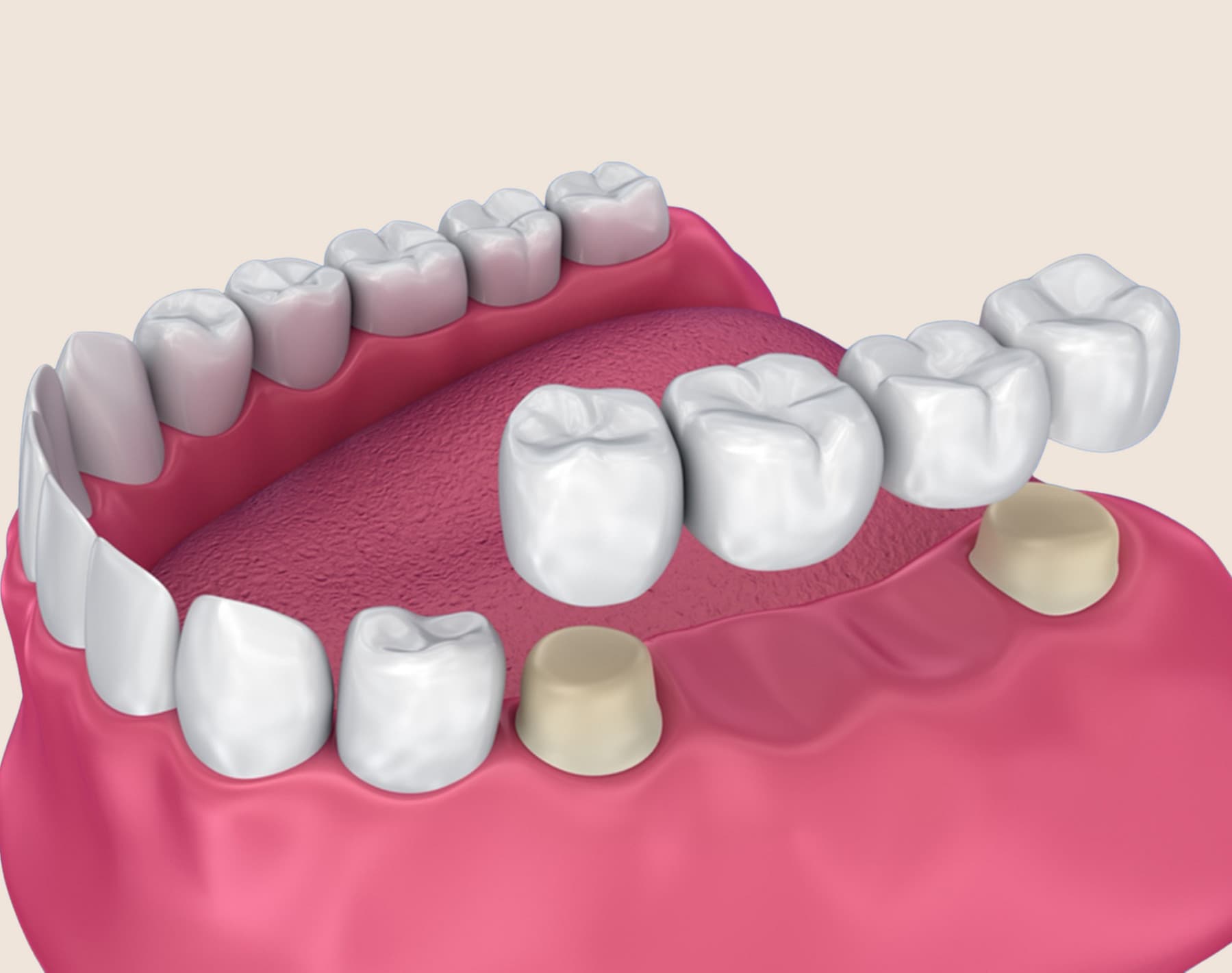 Custom dental bridge restoration crafted for a patient at Rancho Bernardo Dental Arts in San Diego
