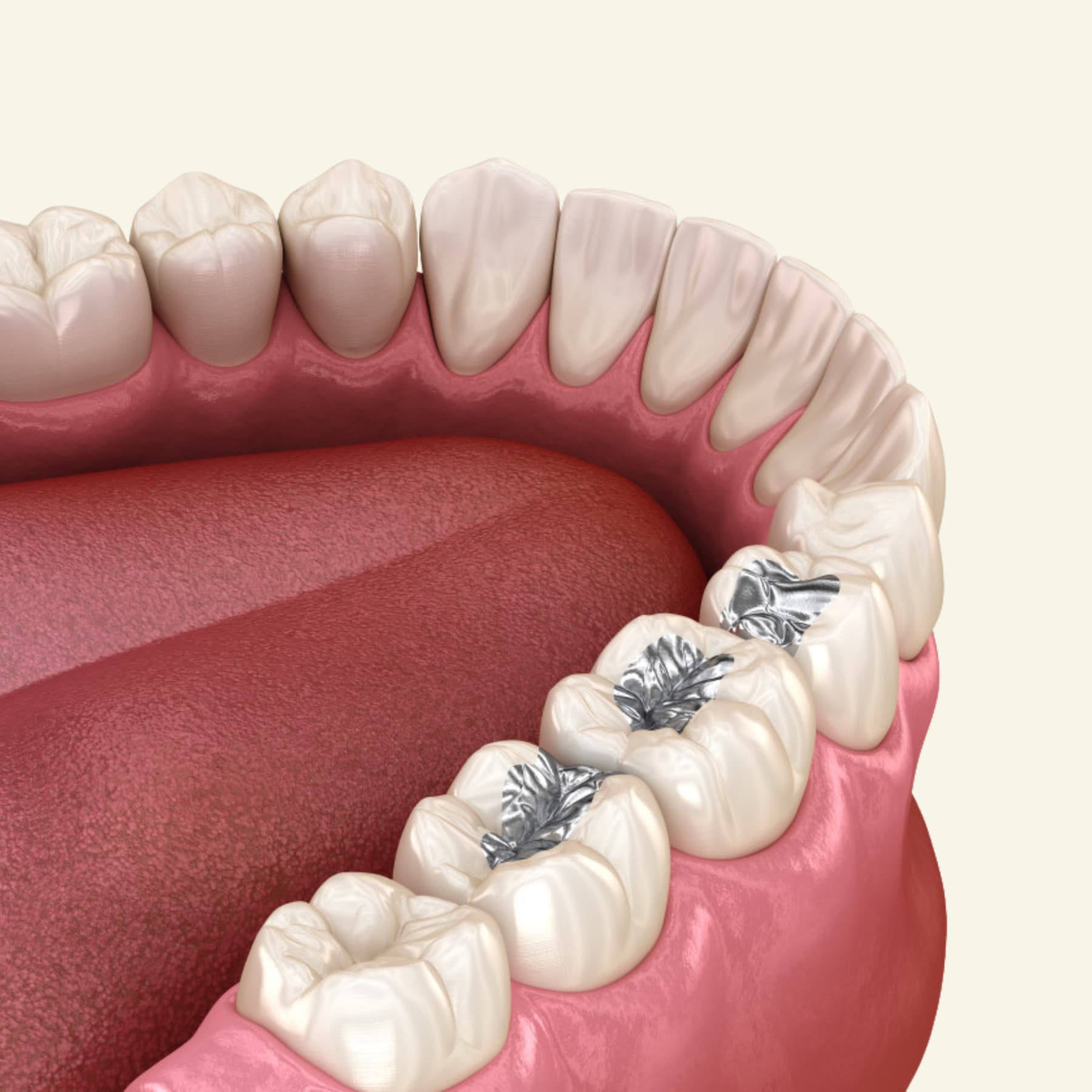 Protective dental sealant applied to a molar at Rancho Bernardo Dental Arts