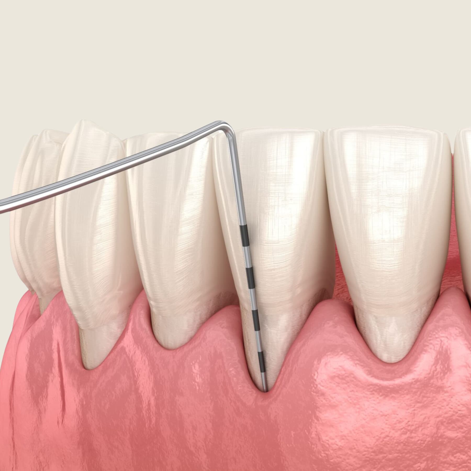 Hygienist measuring gum pocket depths during a periodontal exam at Rancho Bernardo Dental Arts