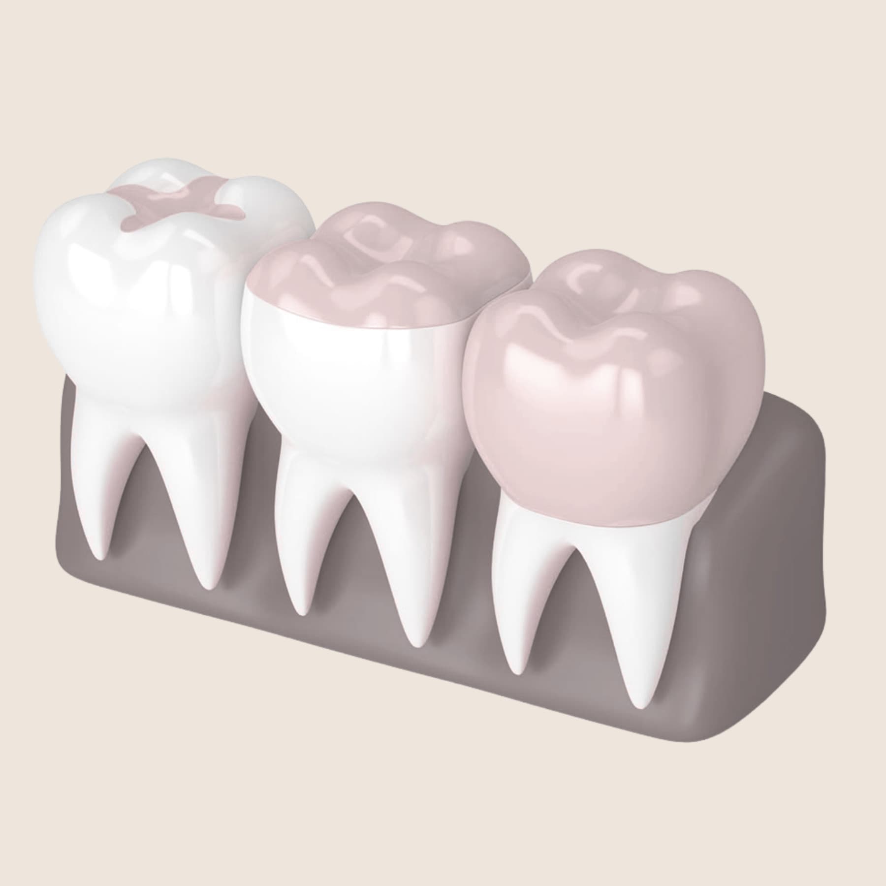 Porcelain onlay restoration precisely fitted at Rancho Bernardo Dental Arts