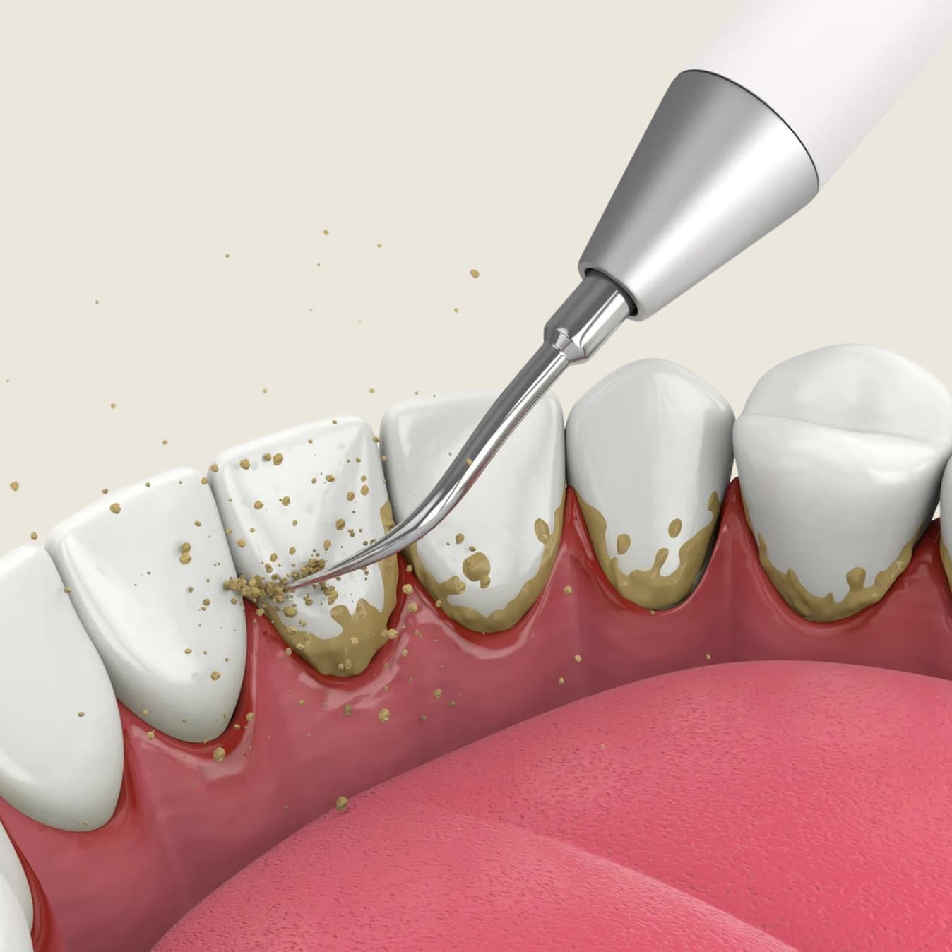 Hygienist explaining regular versus deep cleaning options at Rancho Bernardo Dental Arts