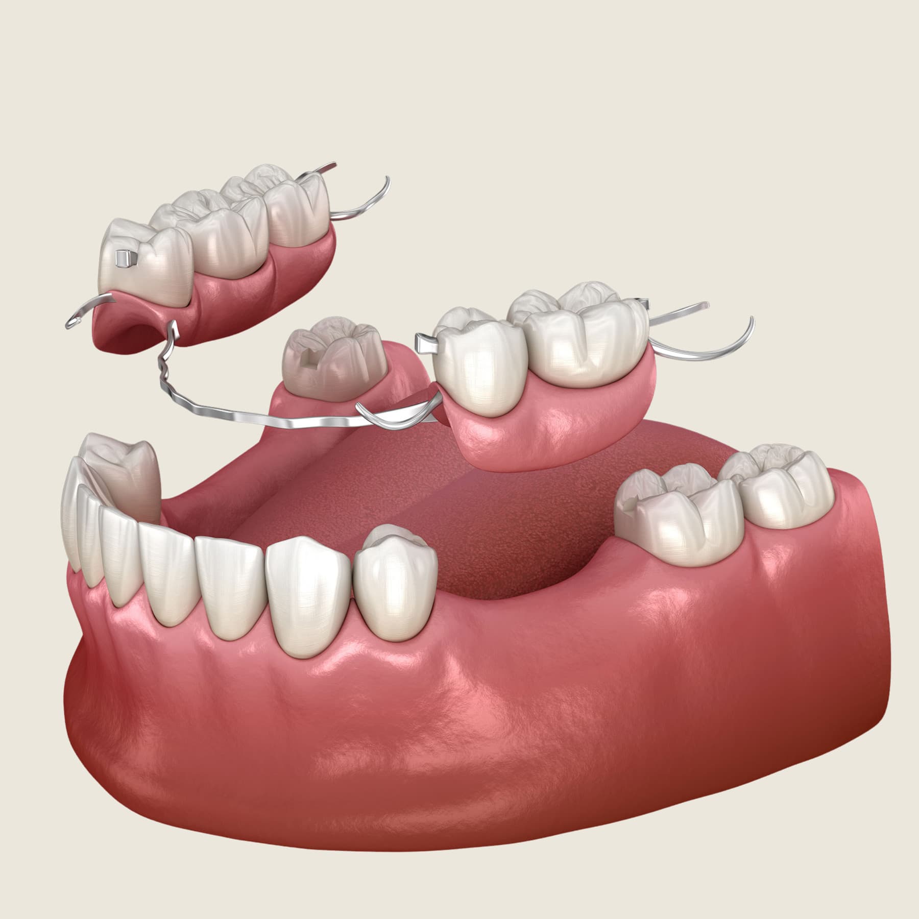 Custom removable partial denture fitted at Rancho Bernardo Dental Arts in San Diego