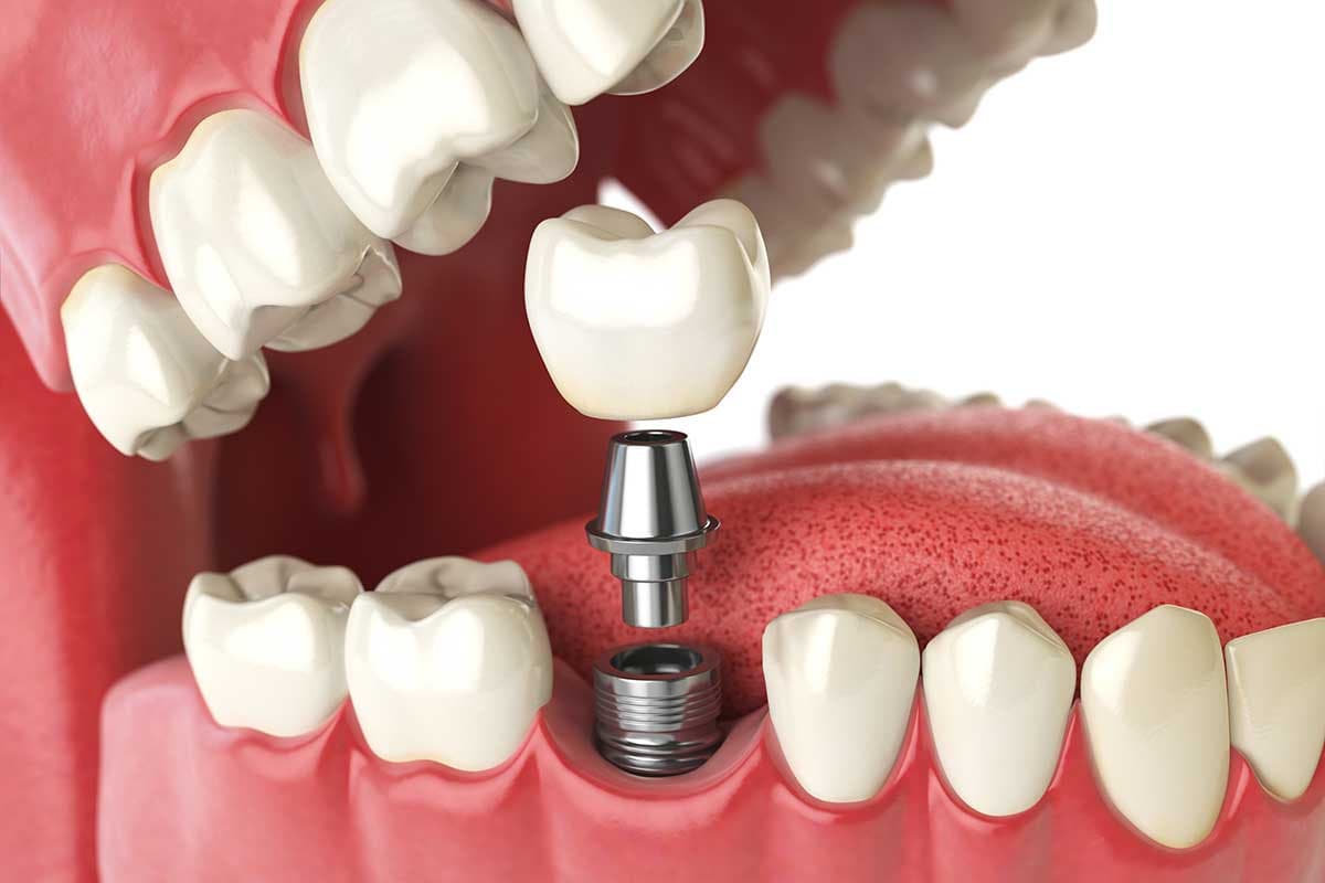 Single tooth implant with crown restoring a complete smile at Rancho Bernardo Dental Arts