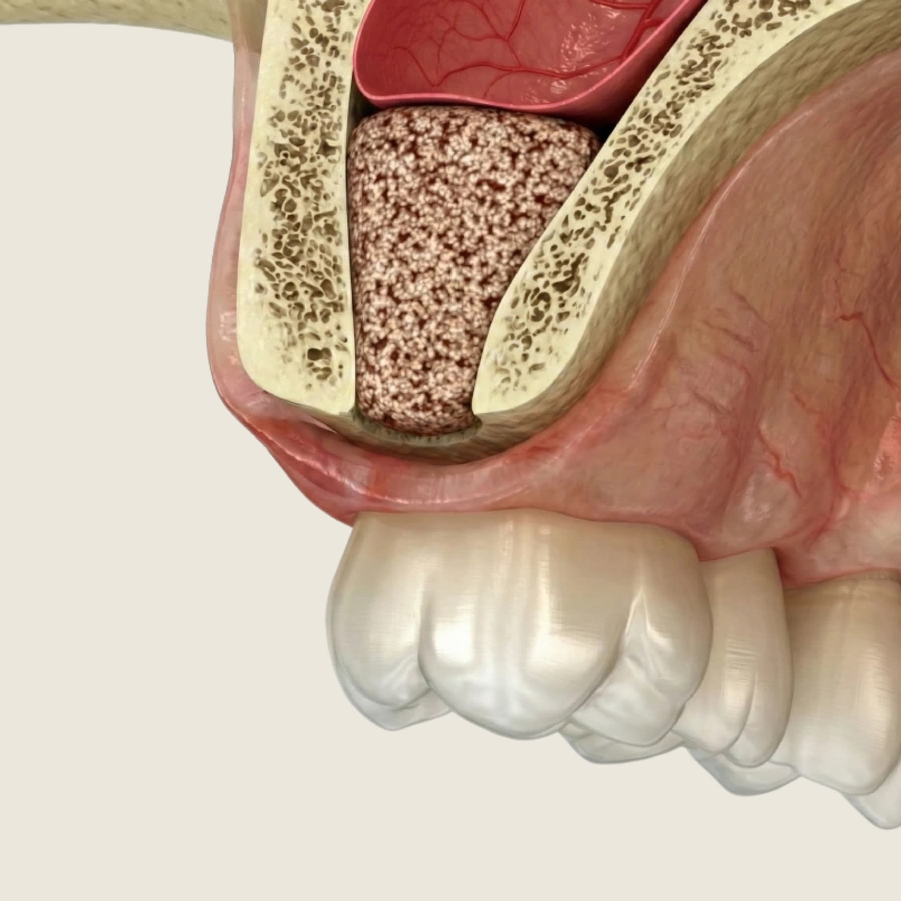 Sinus lift procedure planning with 3D imaging at Rancho Bernardo Dental Arts